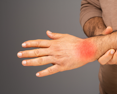 RHEUMATOID ARTHRITIS 2
