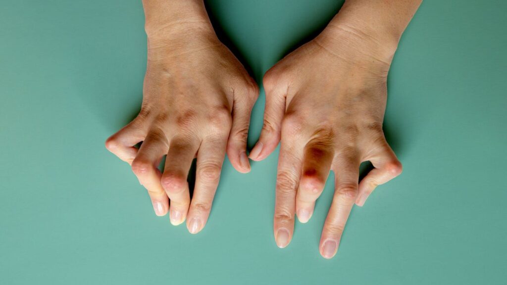 Rheumatoid