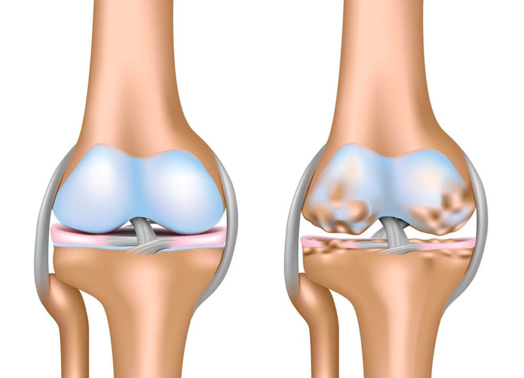 What is Osteoarthritis