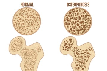 What is Osteoporosis