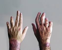 What is Psoriatic Arthritis