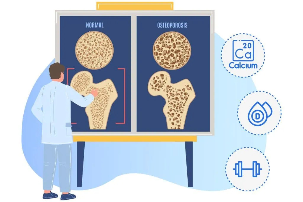 What is the Outlook for Osteoporosis